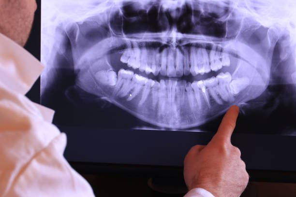 Best Emergency Dentist for Lost Fillings or Crowns in Eastwood, MI